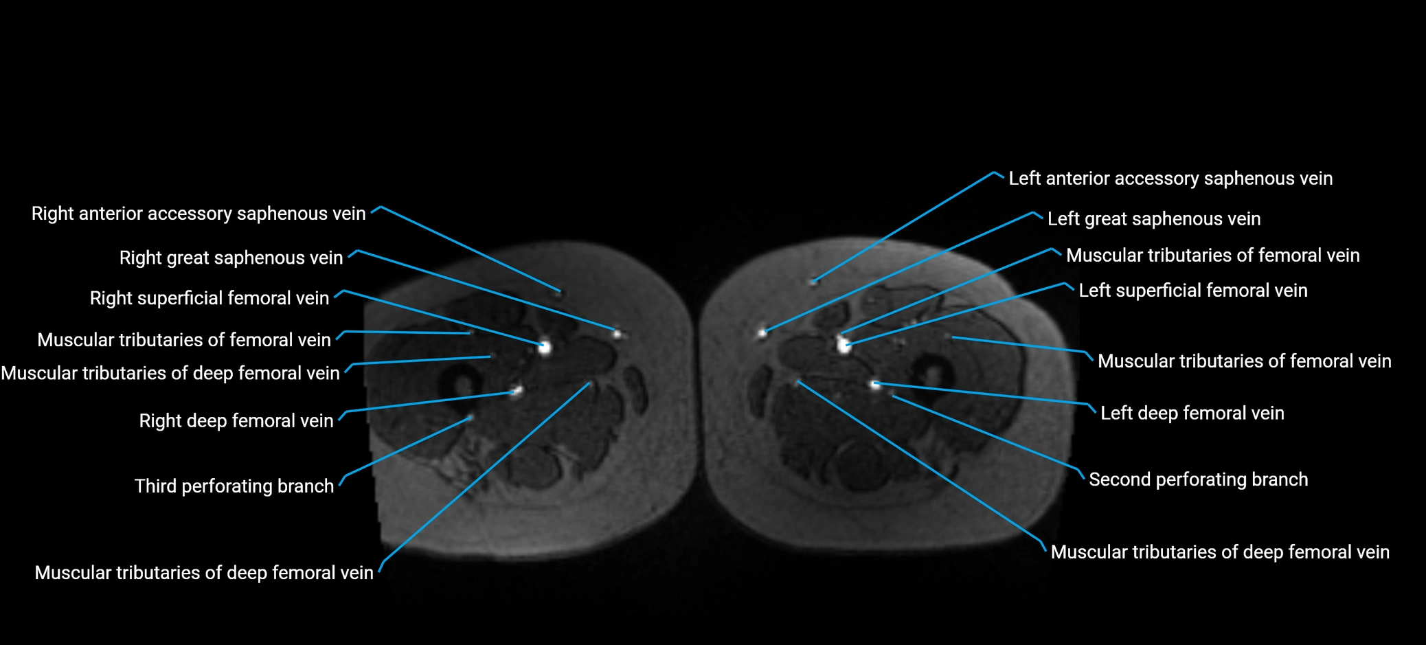 MRV abdomen pelvis & lower limb axial cross sectional anatomy labelled MRI image 244 (1).webp